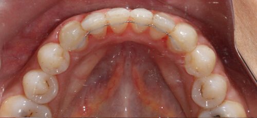 Case 13 - After
