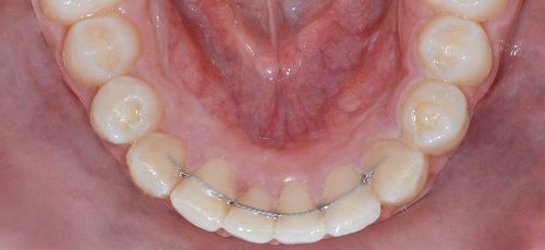 Case 44 - After