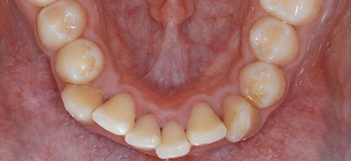 Case 44 - Before