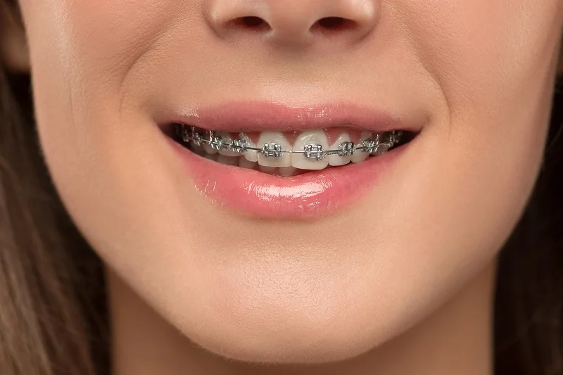Ceramic and Metal Braces in Dubai