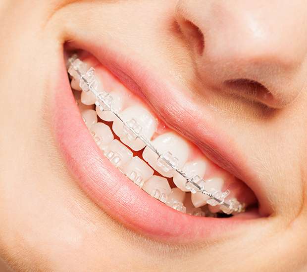 Damon Clear Braces