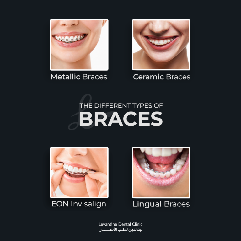 Types of Orthodontic Braces