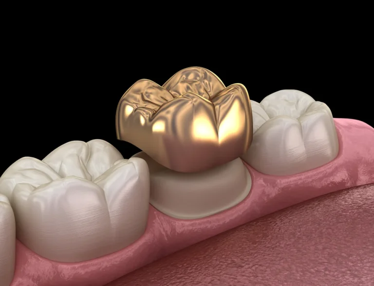 Gold Crowns
