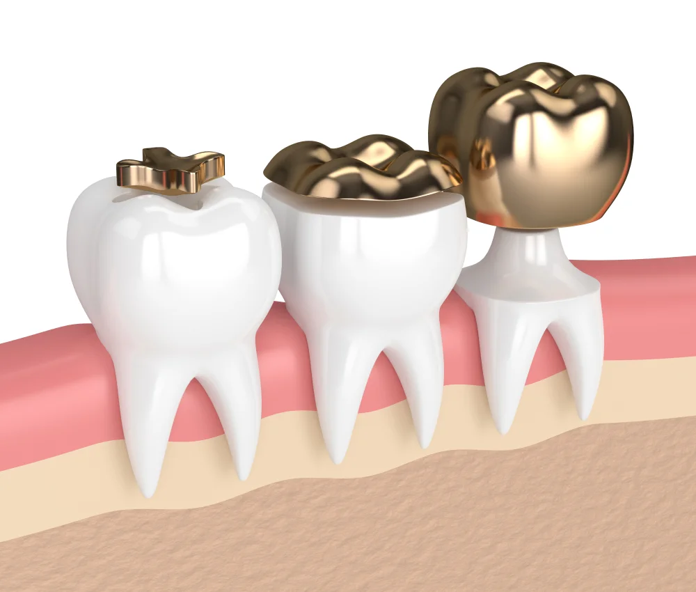 Gold Fillings