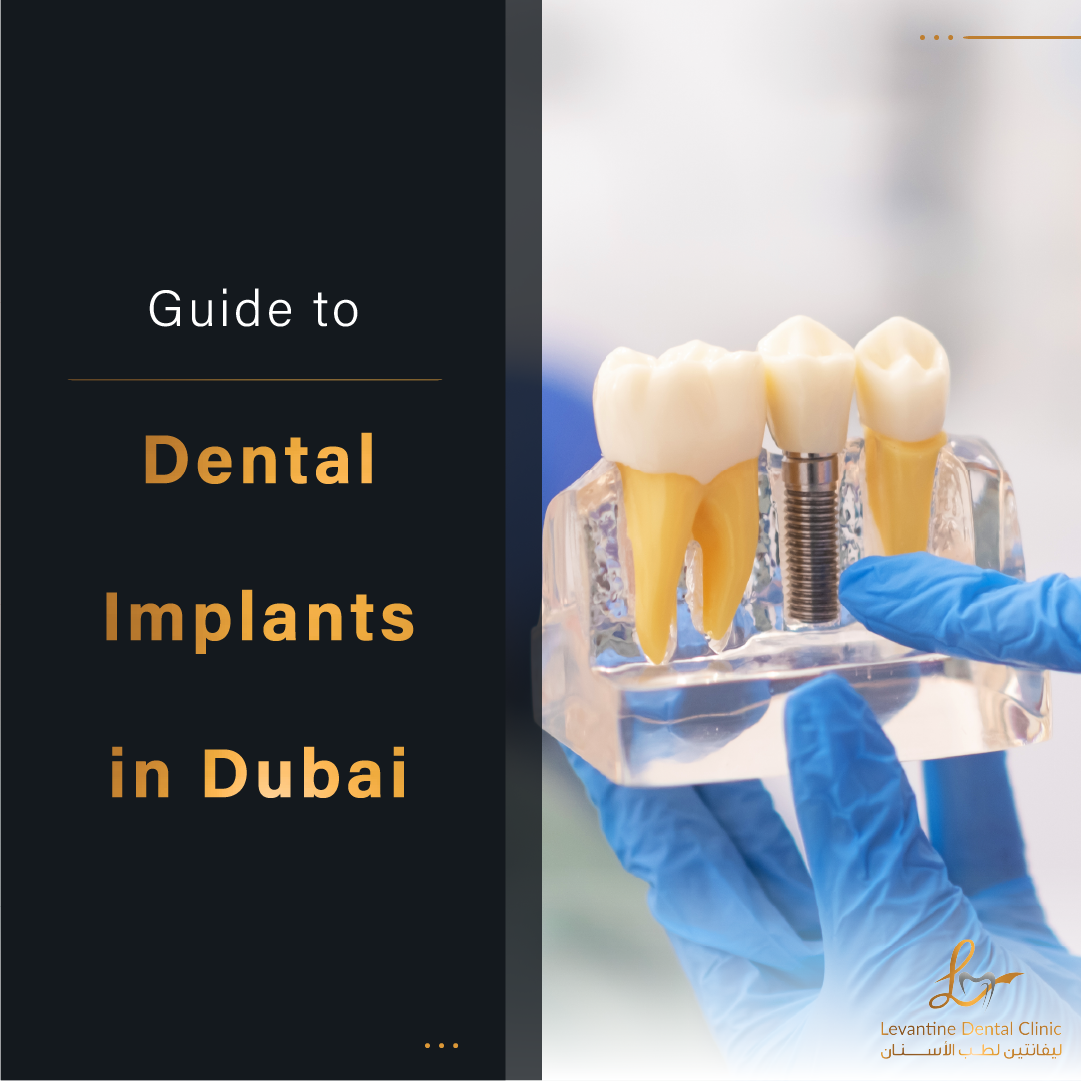 What Are Dental Implants?