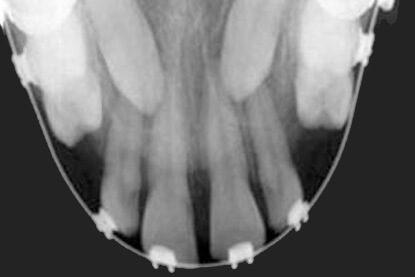 Occlusal X-Ray