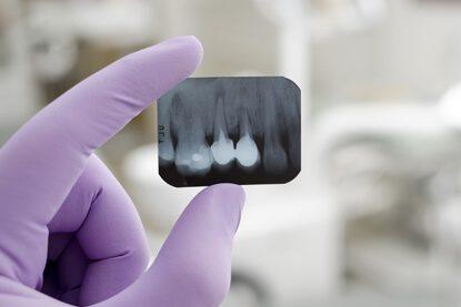 Periapical X-Ray