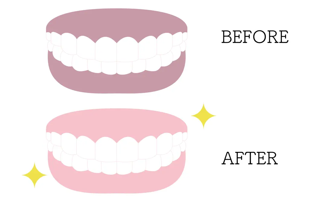 Gum Bleaching Before and After