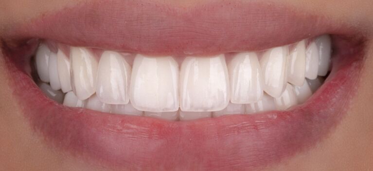Hollywood smile makeover after