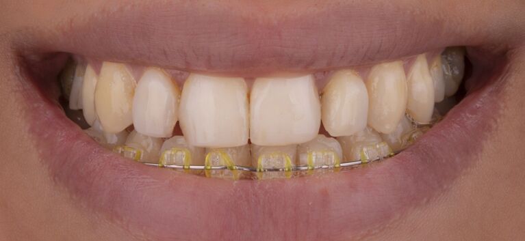 Hollywood smile makeover before