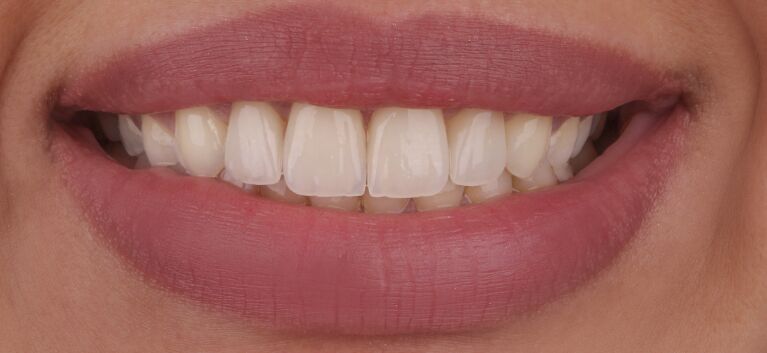 Hollywood smile makeover after