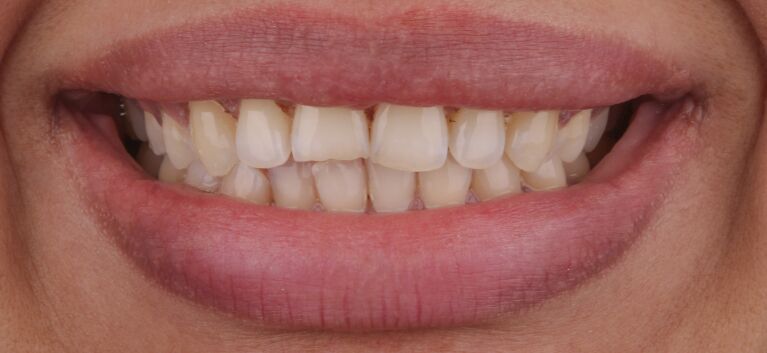 Hollywood smile makeover before