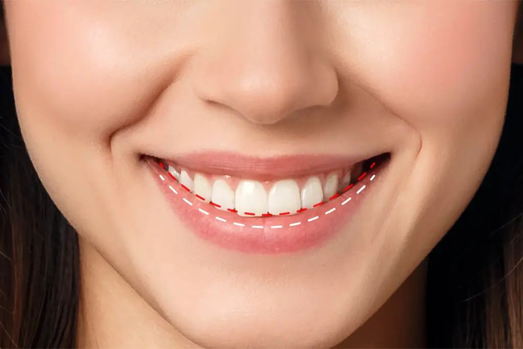 Upper teeth parallel to the lower lip
