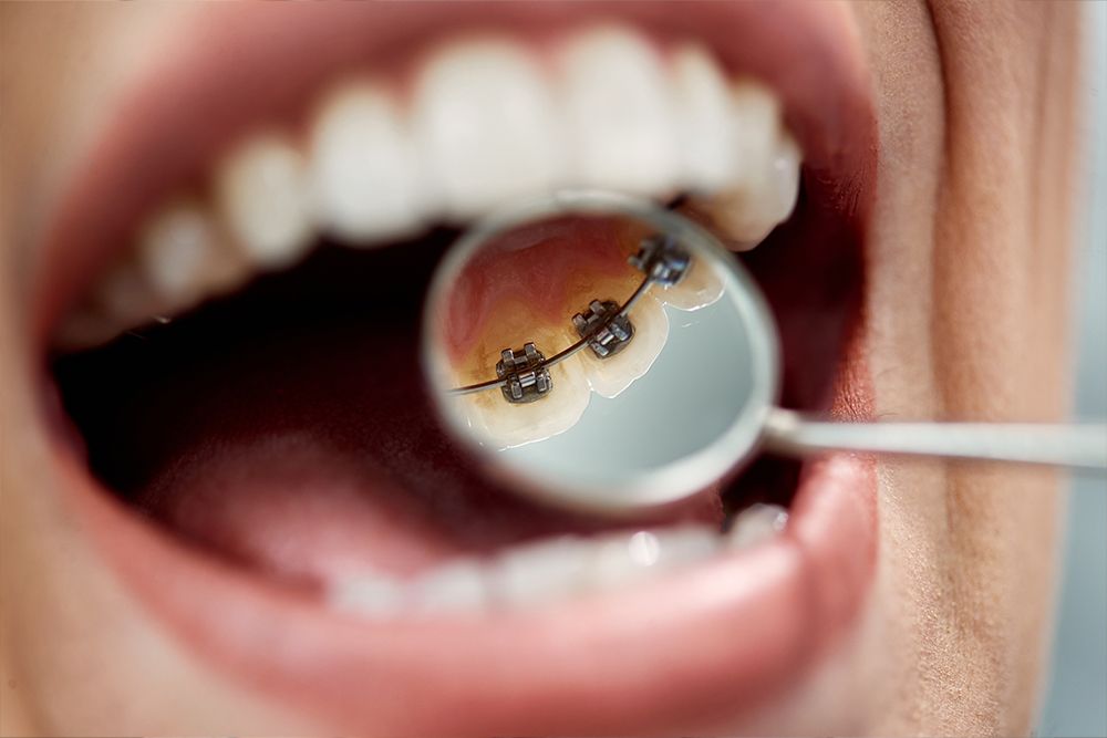 Lingual Braces in Dubai