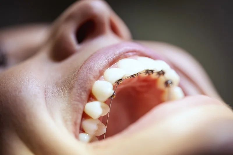 Lingual Braces