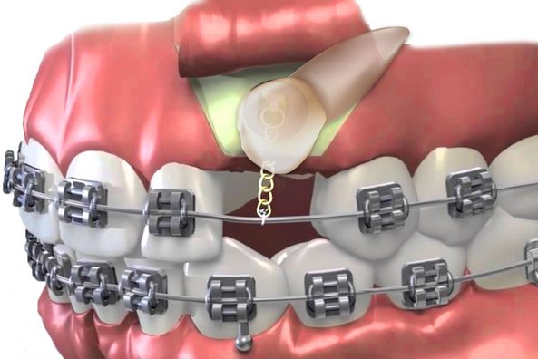 Exposure of Unerupted Teeth