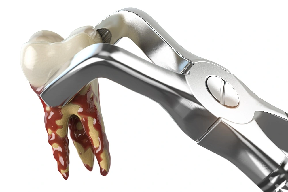 Third Molar Extraction
