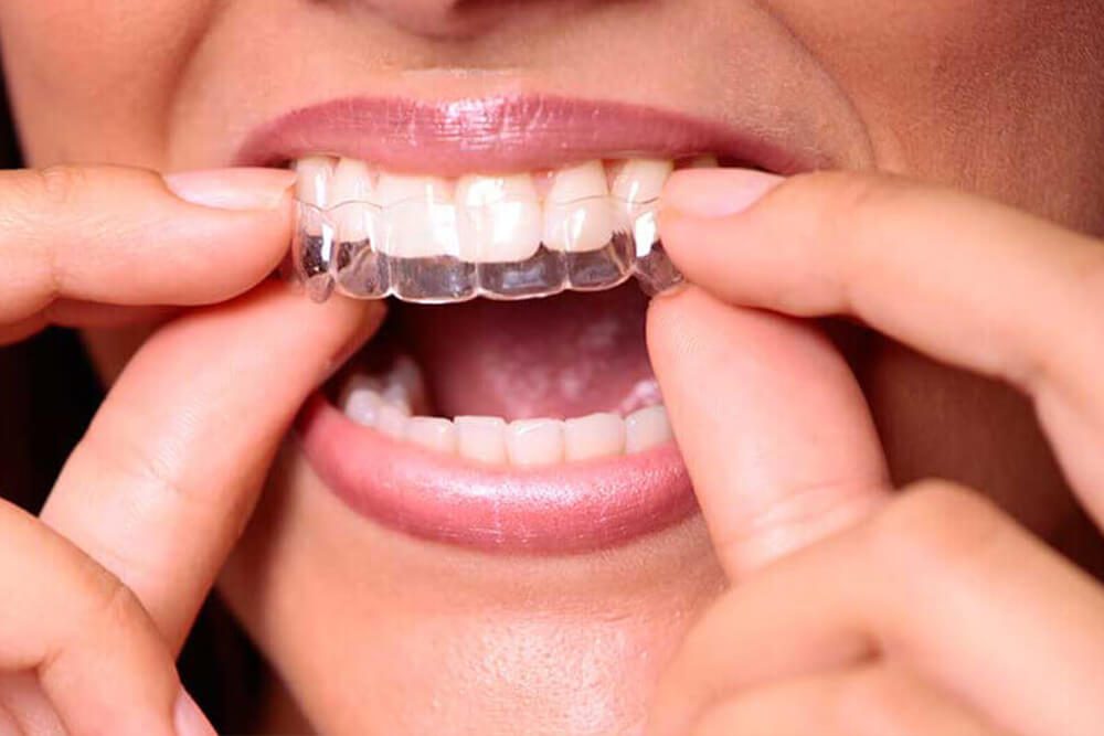 EON Aligner
