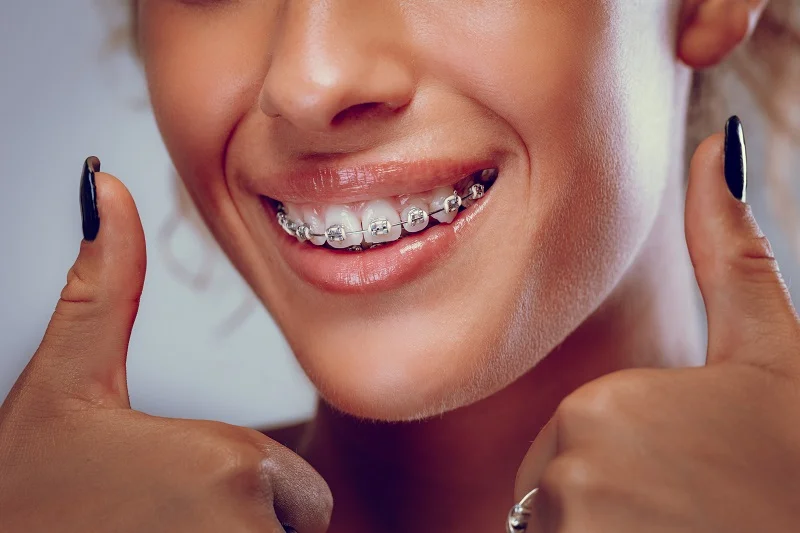 Orthodontic Clinic in Dubai - Braces
