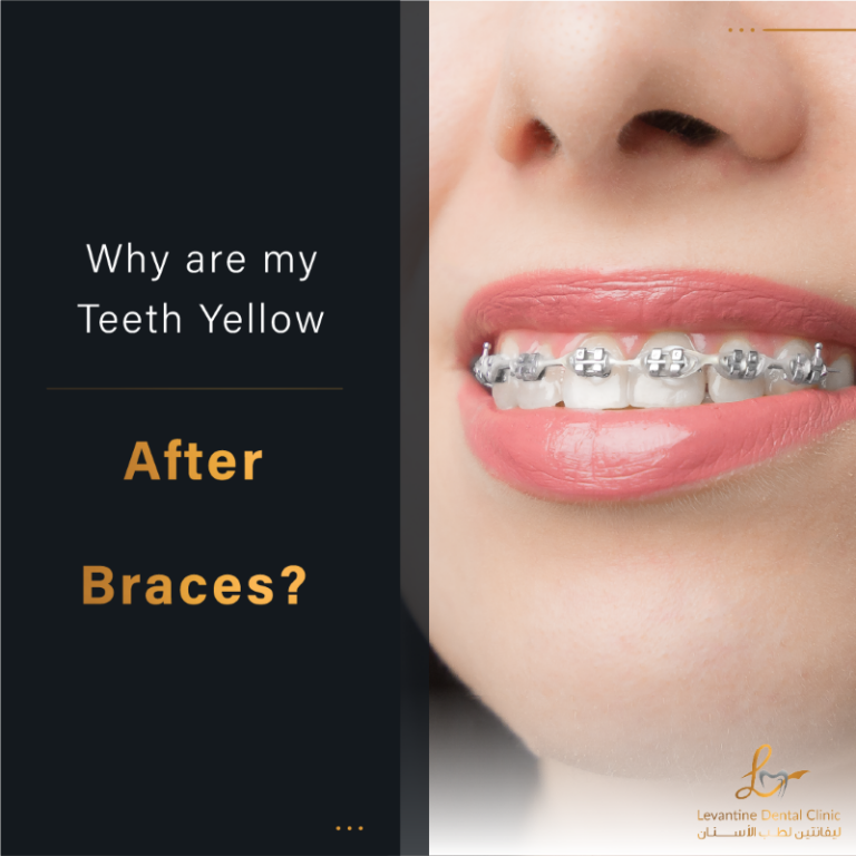 Why are my Teeth Yellow after Braces?