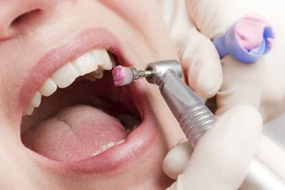 Dental Polishing