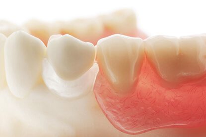 Acrylic Dentures