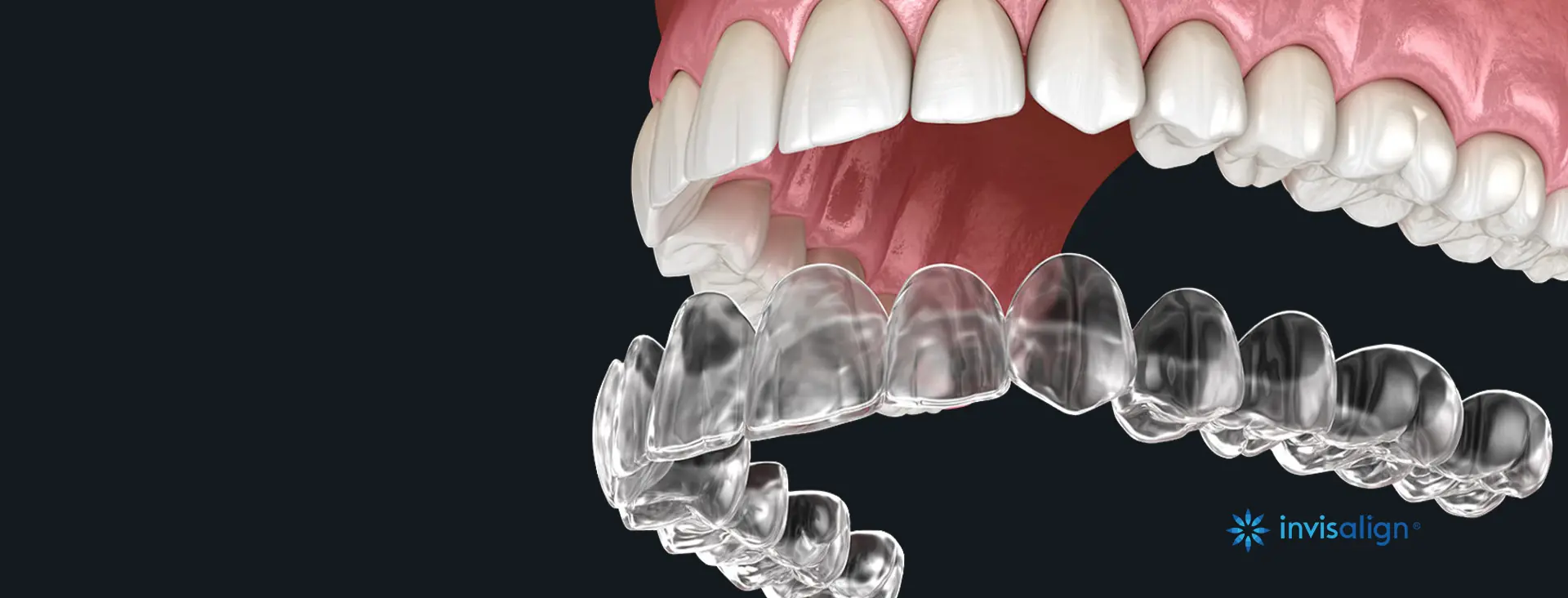 Invisalign