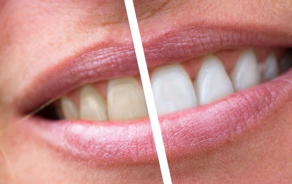 Teeth Whitening Dubai