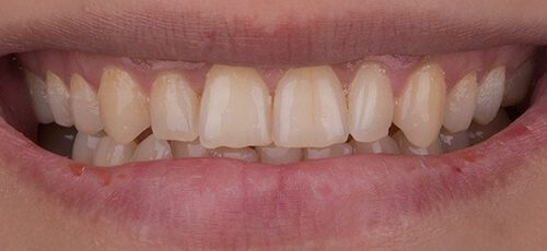 Veneers Case 2 - Before