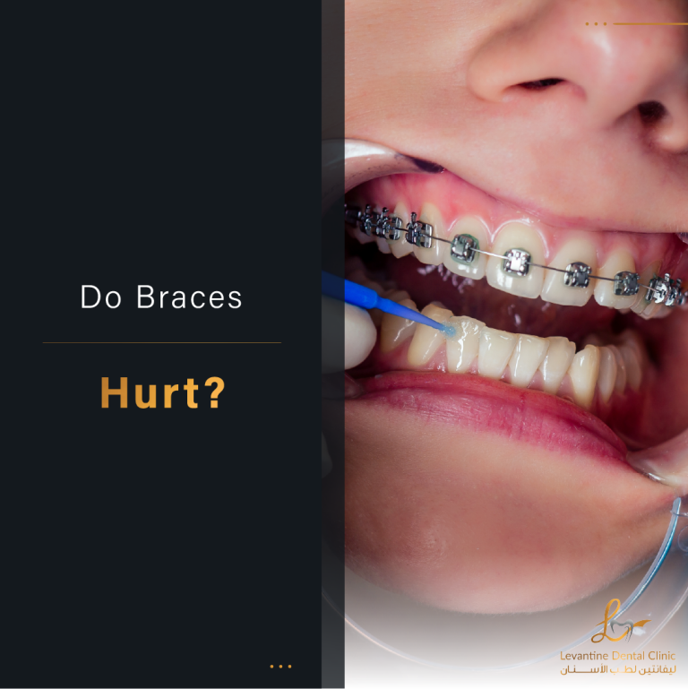Do Braces Hurt?
