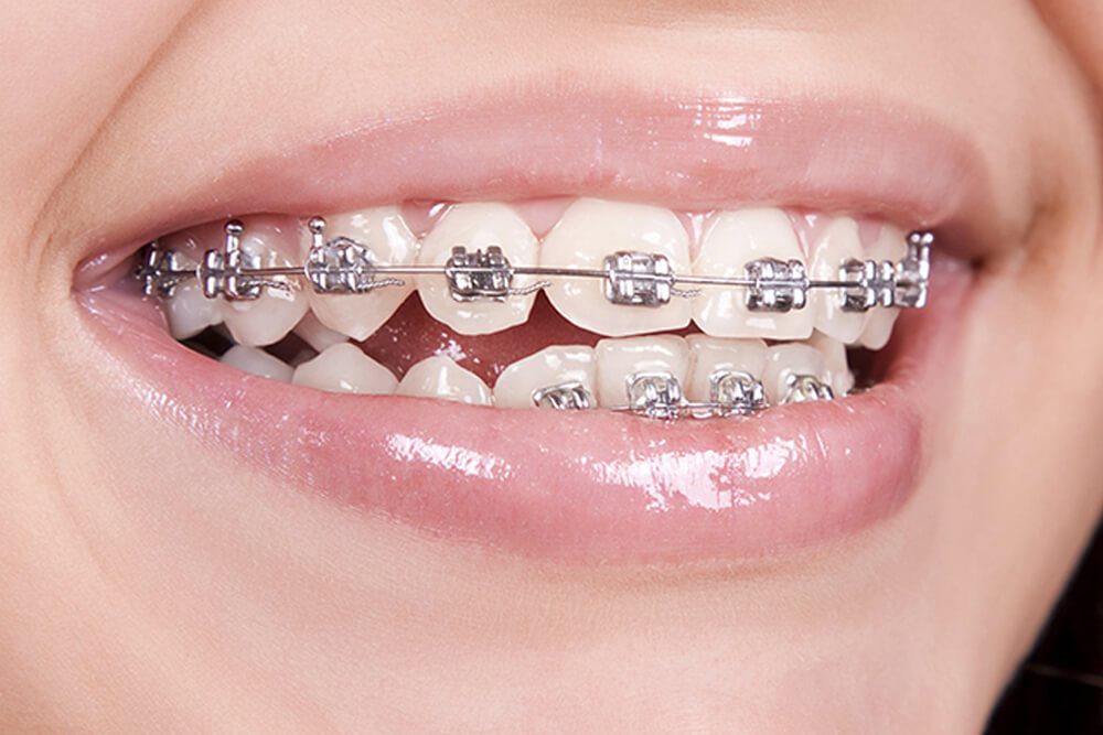 metal-braces-orthodontics-services