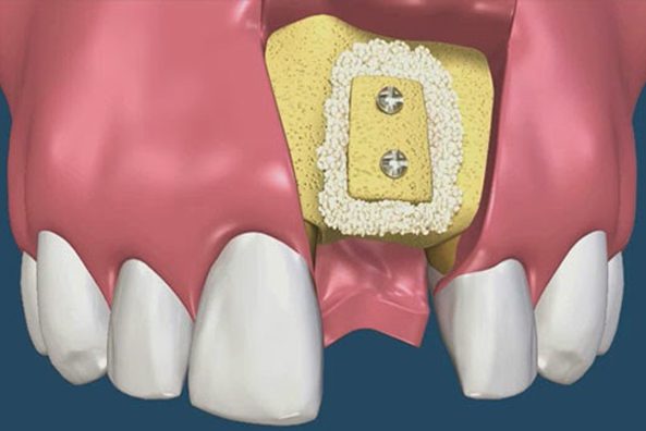 bone grafting oral