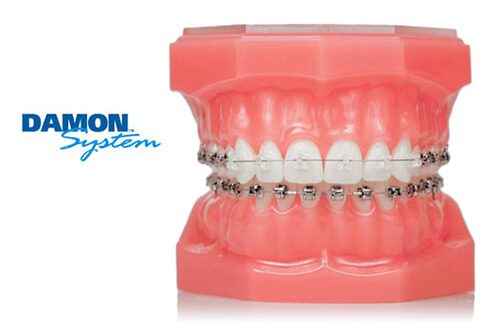 damon braces ortho services 3