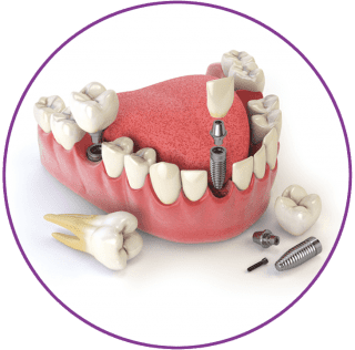 dental implants round 2