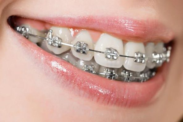 metal braces ortho services1