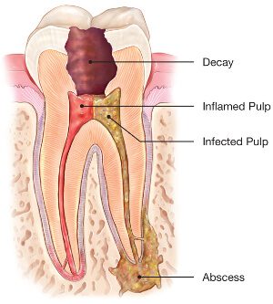 root canal abcessed tooth