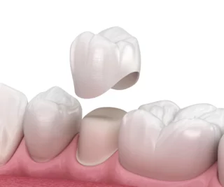 Best Clinic in Dubai for Dental Crowns