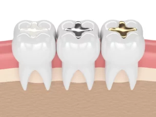 Best Dental Fillings in Dubai