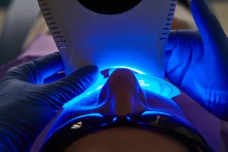 Best Laser Teeth Whitening