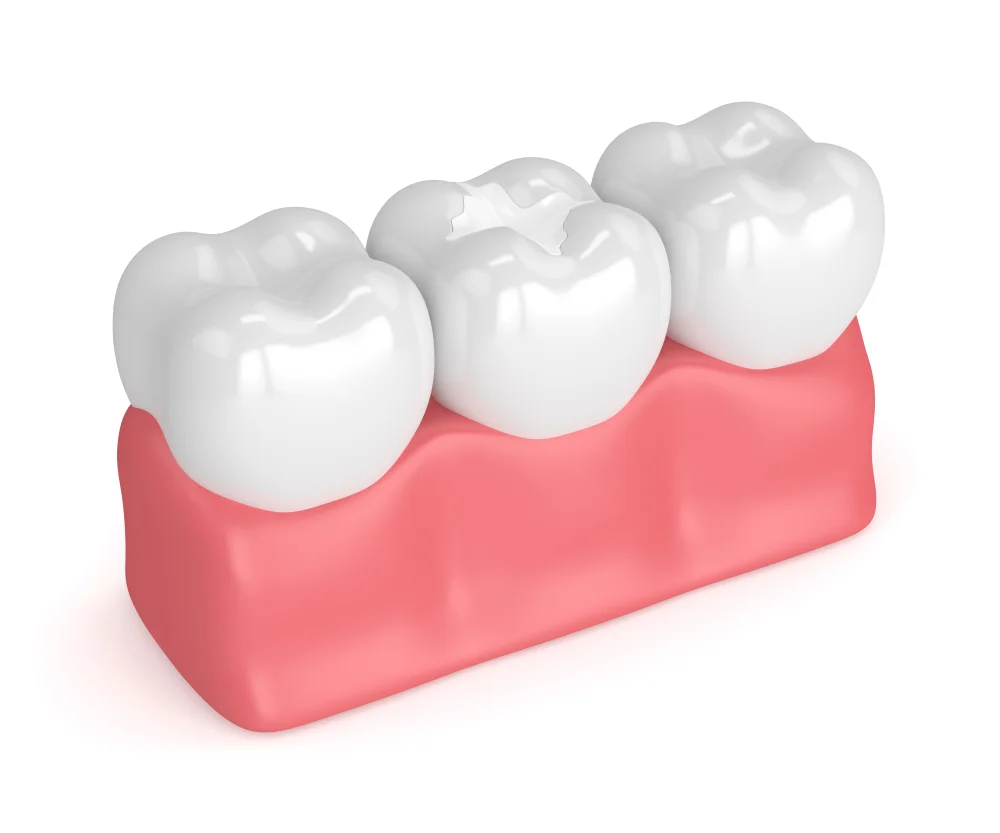 Difference between Composite and Porcelain Fillings