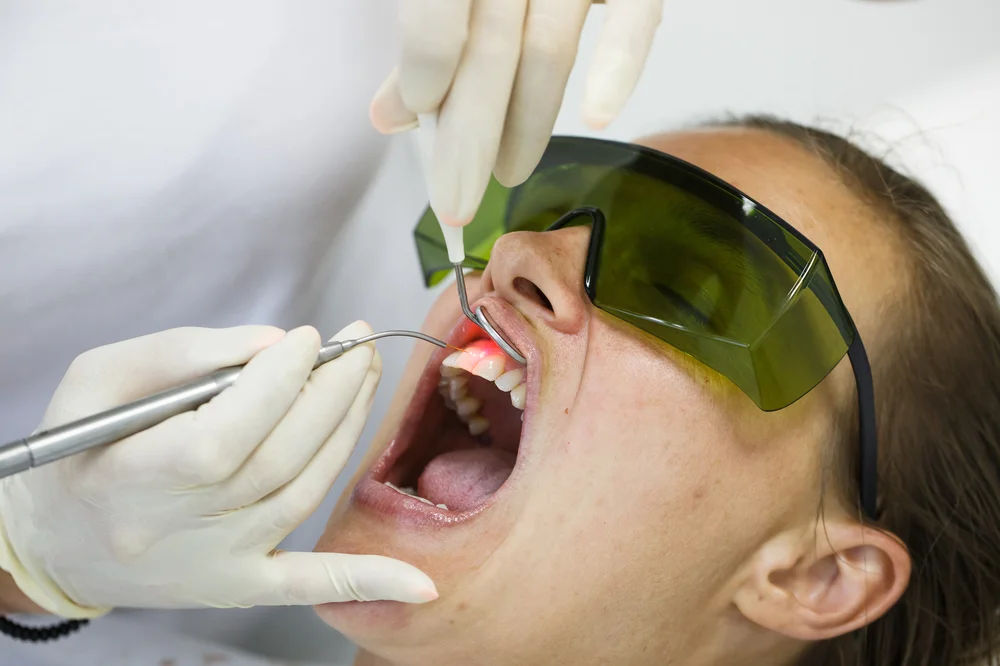 Laser Gingivectomy