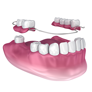 Removable Teeth Dentures