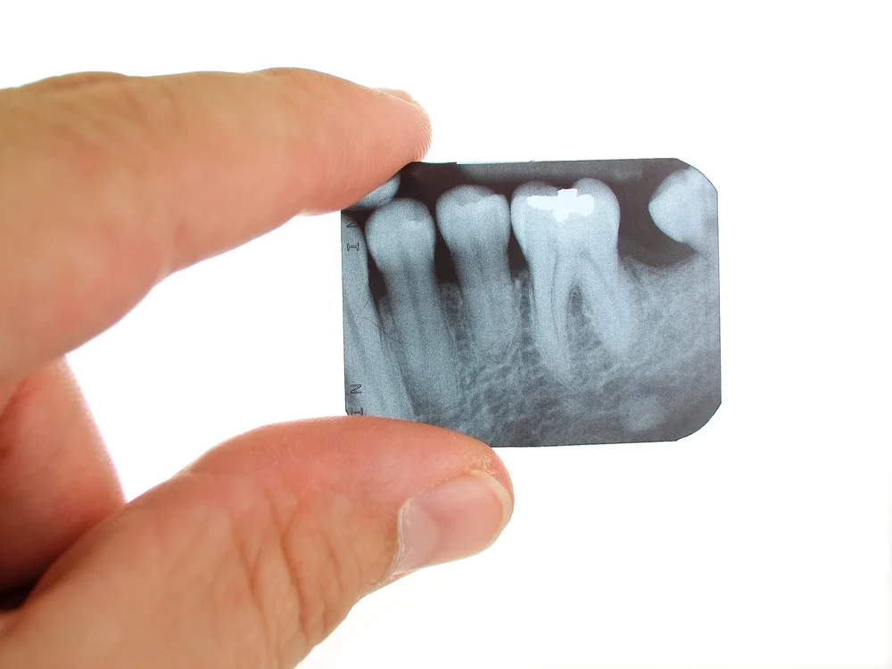 What is Periapical X Ray