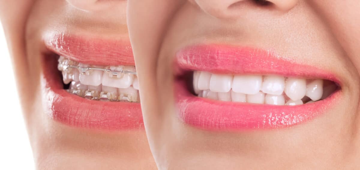 Teeth-Yellow-after-Braces-2-e1663584957999-1200x569.jpg
