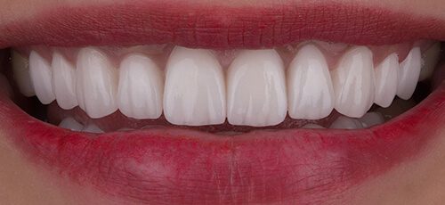 شكل الاسنان بعد تركيب الفينير