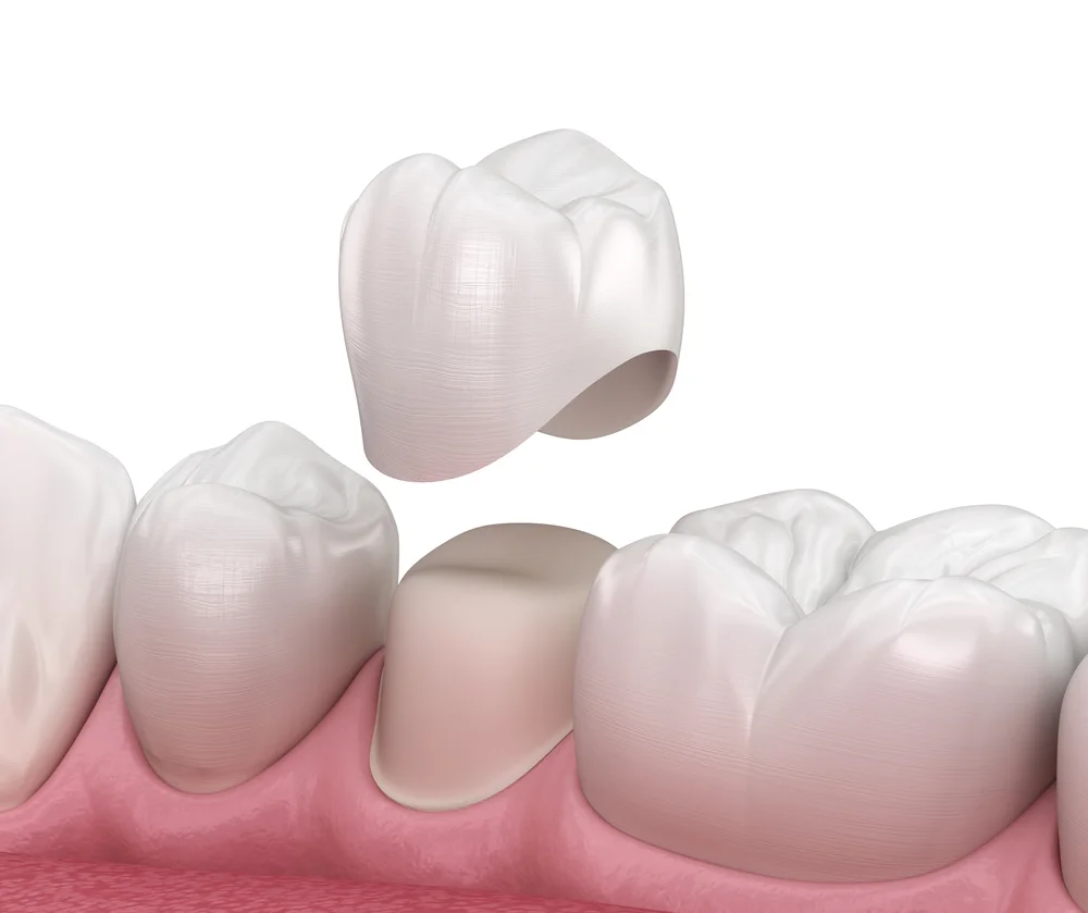 Best Clinic in Dubai for Dental Crowns Dental Crowns