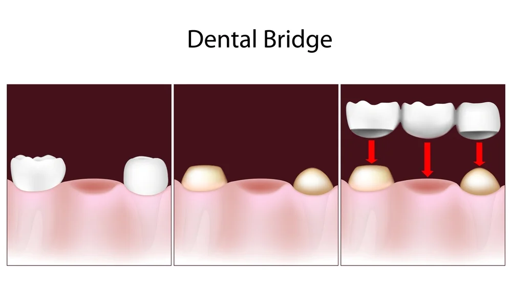 Dental Bridge Procedure Dental Bridges