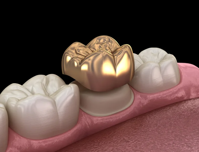 Gold Crowns Dental Crowns