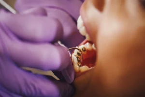 التقويم المخفي ( اللساني) - عيادة ليفانتين 
 لفضل تقويم أسنان في دبي
