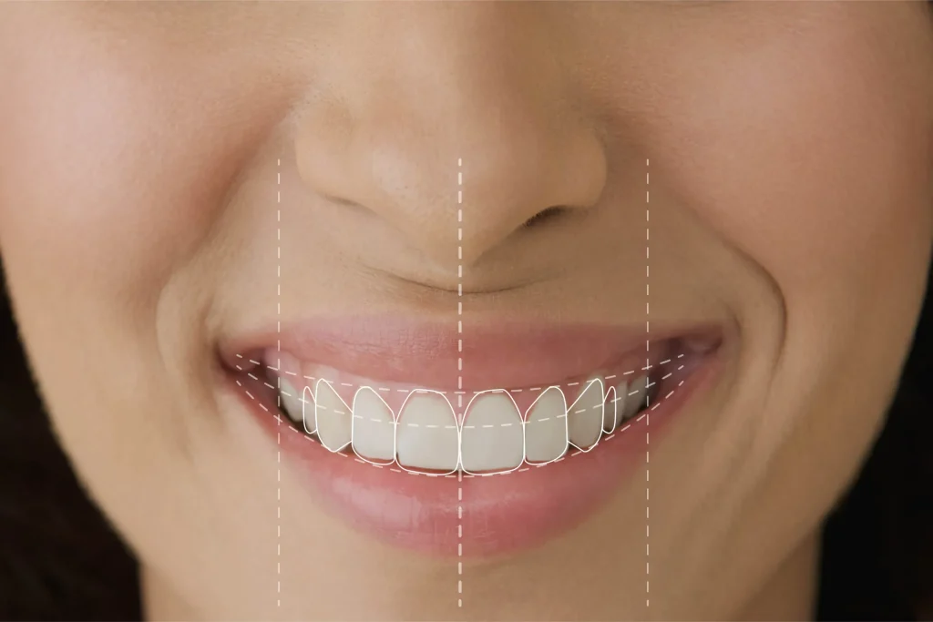 Symmetrical in size shape and length scaled 1 Hollywood Smile